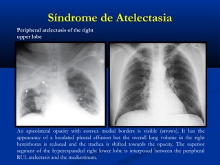 Síndrome de Atelectasia
An apicolateral opacity with convex medial borders is visible (arrows). It has the
appearance of a loculated pleural effusion but the overall lung volume in the right
hemithorax is reduced and the trachea is shifted towards the opacity. The superior
segment of the hyperexpanded right lower lobe is interposed between the peripheral
RUL atelectasis and the mediastinum.
Peripheral atelectasis of the right
upper lobe
 