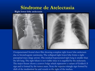 Overpenetrated frontal chest film showing complete right lower lobe atelectasis
due to bronchogenic carcinoma. The collapsed right lower lobe forms a right
paraspinal mass (large arrow). The residual hyperaerated right lung is smaller than
the left lung. The right hilum is not visible since it is engulfed by the atelectasis.
The major fissure shows a convex bulge which represents a variant of Golden's S
sign and is formed by the tumor mass. Note the superior triangle sign formed by
shift of the mediastinal fat and vessels to the right of the trachea.
Right lower lobe atelectasis
Síndrome de Atelectasia
 