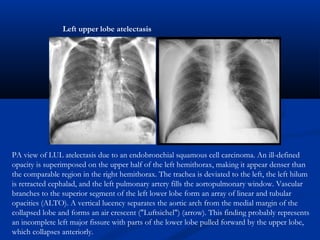 PA view of LUL atelectasis due to an endobronchial squamous cell carcinoma. An ill-defined
opacity is superimposed on the upper half of the left hemithorax, making it appear denser than
the comparable region in the right hemithorax. The trachea is deviated to the left, the left hilum
is retracted cephalad, and the left pulmonary artery fills the aortopulmonary window. Vascular
branches to the superior segment of the left lower lobe form an array of linear and tubular
opacities (ALTO). A vertical lucency separates the aortic arch from the medial margin of the
collapsed lobe and forms an air crescent ("Luftsichel") (arrow). This finding probably represents
an incomplete left major fissure with parts of the lower lobe pulled forward by the upper lobe,
which collapses anteriorly.
Left upper lobe atelectasis
 