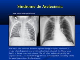 Left lower lobe atelectasis due to an aspirated foreign body in a small child. A
wedge- shaped opacity is seen in retrocardiac location (arrow). Its oblique lateral
border is formed by the major fissure. The left hilum is obscured partially and
displaced caudad. The residual left upper lobe is hyperexpanded, accounting for the
increased lucency in the left hemithorax.
Left lower lobe atelectasis
Síndrome de Atelectasia
 