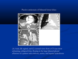 (A) Axial, (B) sagittal, and (C) coronal views from a CT scan show
enhancing, collapsed lobes floating in the large bilateral pleural
effusions of a patient with cirrhosis, ascites, and hepatic hydrothorax
Passive atelectasis of bilateral lower lobes
 