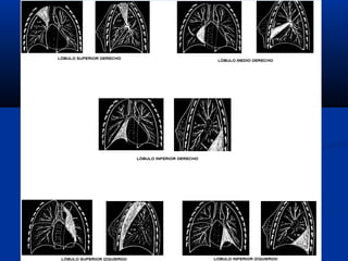 ATELECTASIAS LOBULARES
 