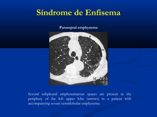 Several subpleural emphysematous spaces are present in the
periphery of the left upper lobe (arrows) in a patient with
accompanying severe centrilobular emphysema
Paraseptal emphysema
Síndrome de Enfisema
 