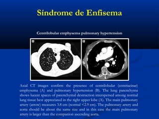 Axial CT images confirm the presence of centrilobular (centriacinar)
emphysema (A) and pulmonary hypertension (B). The lung parenchyma
shows lucent spaces of parenchymal destruction interspersed among normal
lung tissue best appreciated in the right upper lobe (A). The main pulmonary
artery (arrow) measures 3.8 cm (normal <2.9 cm). The pulmonary artery and
aorta should be about the same size and in this case the main pulmonary
artery is larger than the companion ascending aorta.
Centrilobular emphysema pulmonary hypertension
Síndrome de Enfisema
 