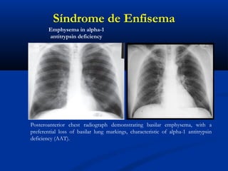 Posteroanterior chest radiograph demonstrating basilar emphysema, with a
preferential loss of basilar lung markings, characteristic of alpha-1 antitrypsin
deficiency (AAT).
Emphysema in alpha-1
antitrypsin deficiency
Síndrome de Enfisema
 