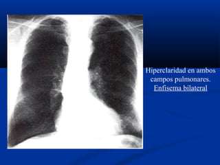 Hiperclaridad en ambos
campos pulmonares.
Enfisema bilateral
 