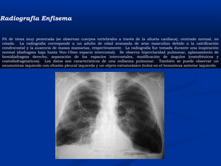 Radiografia Enfisema  
PA de tórax muy penetrada (se observan cuerpos vertebrales a través de la silueta cardiaca), centrado normal, no
rotada. La radiografia corresponde a un adulto de edad avanzada de sexo masculino debido a la calcificación
condrocostal y la ausencia de masas mamarias, respectivamente. La radiografia fue tomada durante una inspiración
normal (diafragma baja hasta 9no-10mo espacio intercostal). Se observa hiperclaridad pulmonar, aplanamiento de
hemidiafragma derecho, separación de los espacios intercostales, modificación de ángulos (costofrénicos y
costodiafragmaticos). Los datos son característicos de una enfisema pulmonar. También se puede observar un
neumotórax izquierdo con efusión pleural izquierda y un objeto extratoráxico (tubo) en el hemotórax anterior izquierdo.
 