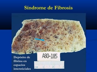 Depósito de
fibrina en
espacios
intersticiales
Síndrome de Fibrosis
 