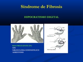 HIPOCRATISMO DIGITAL
MAS FRECUENTE EN:
•FPI
•GRANULOMA EOSINOFILICO
•ASBESTOSIS
Síndrome de Fibrosis
 