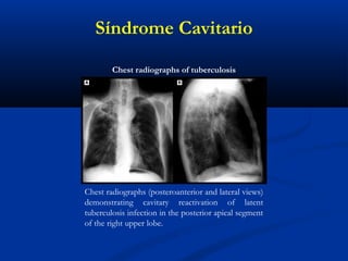 Chest radiographs (posteroanterior and lateral views)
demonstrating cavitary reactivation of latent
tuberculosis infection in the posterior apical segment
of the right upper lobe.
Chest radiographs of tuberculosis
Síndrome Cavitario
 