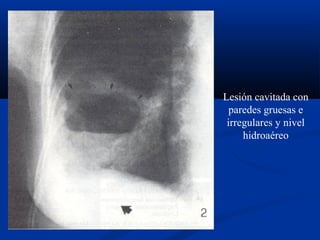 Lesión cavitada con
paredes gruesas e
irregulares y nivel
hidroaéreo
 