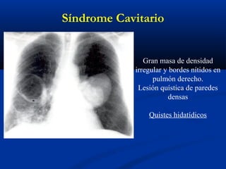Gran masa de densidad
irregular y bordes nítidos en
pulmón derecho.
Lesión quística de paredes
densas
Quistes hidatídicos
Síndrome Cavitario
 