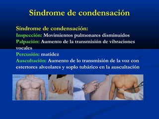 Síndrome de condensación:
Inspección: Movimientos pulmonares disminuidos
Palpación: Aumento de la transmisión de vibraciones
vocales
Percusión: matidez
Auscultación: Aumento de lo transmisión de la voz con
estertores alveolares y soplo tubárico en la auscultación
Síndrome de condensación
 