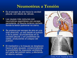 Neumotórax a Tensión
 Es el escape de aire hacia la cavidadEs el escape de aire hacia la cavidad
pleural, con efecto de válvula.pleural, con efecto de válvula.
 Las causas más comunes sonLas causas más comunes son
neumotórax espontáneo con escapeneumotórax espontáneo con escape
persistente, el trauma torácico cerradopersistente, el trauma torácico cerrado
donde la lesión pulmonar no cierra.donde la lesión pulmonar no cierra.
 Se produce por escape de aire en unaSe produce por escape de aire en una
sola dirección, ya sea desde el pulmónsola dirección, ya sea desde el pulmón
o de la pared, acumulándose en lao de la pared, acumulándose en la
cavidad pleural, y sin posibilidad decavidad pleural, y sin posibilidad de
salida, produciendo el colapso delsalida, produciendo el colapso del
pulmón.pulmón.
 El mediastino y la traquea se desplazanEl mediastino y la traquea se desplazan
hacia el lado opuesto, comprometiendohacia el lado opuesto, comprometiendo
la posibilidad de respuesta ventilatoriala posibilidad de respuesta ventilatoria
por parte del pulmón sano, y afectandopor parte del pulmón sano, y afectando
el retorno venoso.el retorno venoso.
Contú, P (s/f) Trauma de Tórax.
 