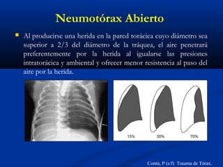 Neumotórax Abierto
 Al producirse una herida en la pared torácica cuyo diámetro sea
superior a 2/3 del diámetro de la tráquea, el aire penetrará
preferentemente por la herida al igualarse las presiones
intratorácica y ambiental y ofrecer menor resistencia al paso del
aire por la herida.
Contú, P (s/f) Trauma de Tórax.
 