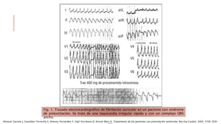 Fig. 1. Trazado electrocardiográfico de fibrilación auricular en un paciente con síndrome
de preexcitación. Se trata de una taquicardia irregular rápida y con un complejo QRS
ancho.
Almeral-Garrote J, González-Torrecilla E, Atienza-Fernández F, Vigil-Escribano D, Arenal-Maiz A. Tratamiento de los pacientes con preexitación ventricular. Rev Esp Cardiol. 2004; 57(9). 859-
 