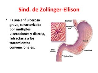 Sind. de Zollinger-Ellison
• Es una enf ulcerosa
  grave, caracterizada
  por mùltiples
  ulceraciones y diarrea,
  refrac...