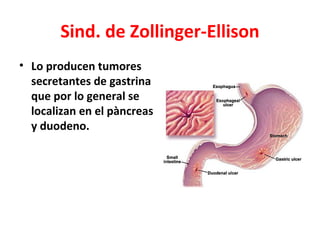 Sind. de Zollinger-Ellison
• Lo producen tumores
  secretantes de gastrina
  que por lo general se
  localizan en el pàncr...