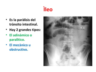 Ìleo
• Es la paràlisis del
  trànsito intestinal.
• Hay 2 grandes tipos:
• El adinàmico o
  paralìtico.
• El mecànico u
  ...