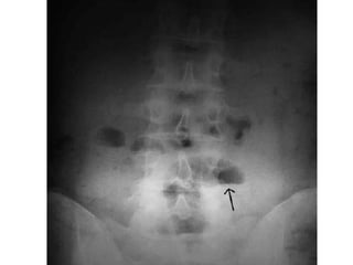 Diagnòstico
• Radiografìa simple de
  abdomen
• Una proyecciòn en
  posiciòn de piè y otra
  en decùbito.
• La primera es ...
