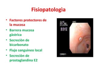 Fisiopatologìa
• Factores protectores de
  la mucosa
• Barrera mucosa
  gàstrica
• Secreciòn de
  bicarbonato
• Flujo sang...
