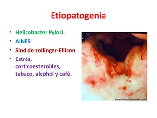 Etiopatogenia
•   Helicobacter Pylori.
•   AINES
•   Sind de zollinger-Ellison
•   Estrès,
    corticoesteroides,
    taba...