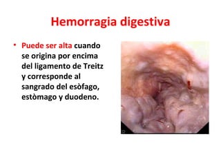 Causas de hemorragia digestiva
              alta
• Ulcera gàstrica o
  duodenal.
• Vàrices esofàgicas.
• Sind de Mallory-...