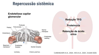 Repercussão sistêmica
Redução TFG
Proteinúria
Retenção de ácido
úrico
Endoteliose capilar
glomerular
CUNNINGHAM et al., 2018 ; IVES et al., 2020 ; ZUGAIB 2020.
 