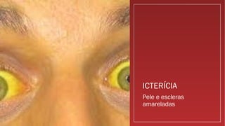 ICTERÍCIA
Pele e escleras
amareladas
 