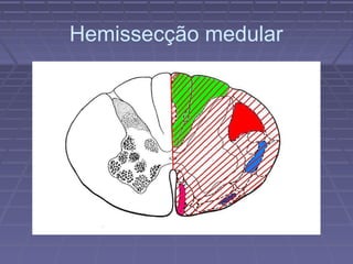 Hemissecção medular 
 