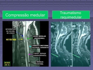 Compressão medular Traumatismo 
raquimedular 
 