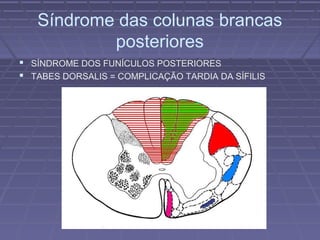 Síndrome das colunas brancas 
posteriores 
 SÍNDROME DOS FUNÍCULOS POSTERIORES 
 TABES DORSALIS = COMPLICAÇÃO TARDIA DA SÍFILIS 
 