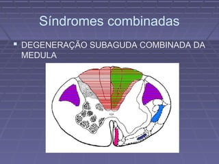 Síndromes combinadas 
 DEGENERAÇÃO SUBAGUDA COMBINADA DA 
MEDULA 
 