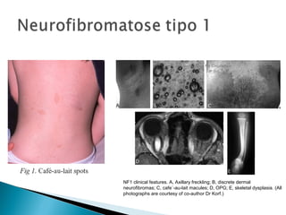 NF1 clinical features. A, Axillary freckling; B, discrete dermal 
neurofibromas; C, cafe´-au-lait macules; D, OPG; E, skeletal dysplasia. (All 
photographs are courtesy of co-author Dr Korf.) 
 