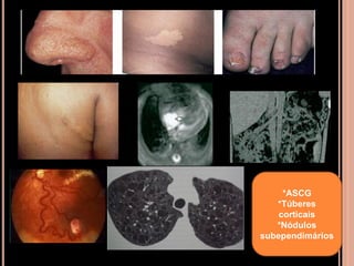 *ASCG
*Túberes
corticais
*Nódulos
subependimários
 