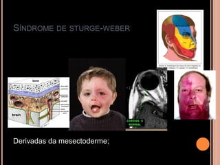 SÍNDROME DE STURGE-WEBER
Derivadas da mesectoderme;
 