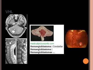 VHL
 