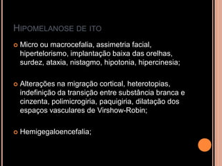HIPOMELANOSE DE ITO
 Micro ou macrocefalia, assimetria facial,
hipertelorismo, implantação baixa das orelhas,
surdez, ataxia, nistagmo, hipotonia, hipercinesia;
 Alterações na migração cortical, heterotopias,
indefinição da transição entre substância branca e
cinzenta, polimicrogiria, paquigiria, dilatação dos
espaços vasculares de Virshow-Robin;
 Hemigegaloencefalia;
 