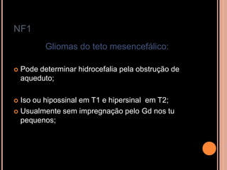 NF1
Gliomas do teto mesencefálico:
 Pode determinar hidrocefalia pela obstrução de
aqueduto;
 Iso ou hipossinal em T1 e hipersinal em T2;
 Usualmente sem impregnação pelo Gd nos tu
pequenos;
 