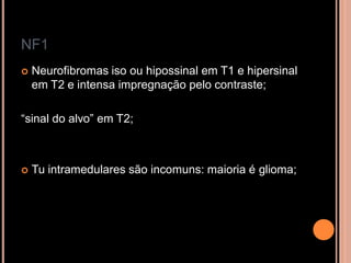 NF1
 Neurofibromas iso ou hipossinal em T1 e hipersinal
em T2 e intensa impregnação pelo contraste;
“sinal do alvo” em T2;
 Tu intramedulares são incomuns: maioria é glioma;
 
