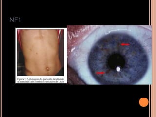 NF1
 