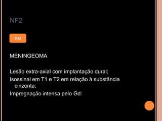 NF2
MENINGEOMA
Lesão extra-axial com implantação dural;
Isossinal em T1 e T2 em relação à substância
cinzenta;
Impregnação intensa pelo Gd:
RM
 