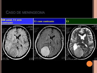 CASO DE MENINGEOMA
 
