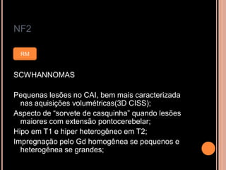NF2
SCWHANNOMAS
Pequenas lesões no CAI, bem mais caracterizada
nas aquisições volumétricas(3D CISS);
Aspecto de “sorvete de casquinha” quando lesões
maiores com extensão pontocerebelar;
Hipo em T1 e hiper heterogêneo em T2;
Impregnação pelo Gd homogênea se pequenos e
heterogênea se grandes;
RM
 