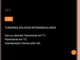 NF2
TUMORES SÓLIDOS INTRAMEDULARES
Isso ou discreto hiperssinal em T1;
Hiperssinal em T2;
Impregnação intensa pelo Gd;
RM
 