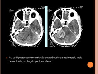  Iso ou hipoatenuante em relação ao parênquima e realce pelo meio
de contraste, no ângulo pontocerebelar;
 