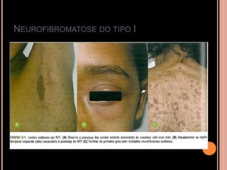 NEUROFIBROMATOSE DO TIPO I
 