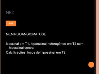 NF2
MENINGOANGIOMATOSE
Isossinal em T1, hiperssinal heterogêneo em T2 com
hipossinal central;
Calcificações: focos de hipossinal em T2
RM
 