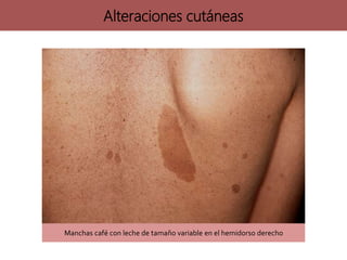 Alteraciones cutáneas
Manchas café con leche de tamaño variable en el hemidorso derecho
 