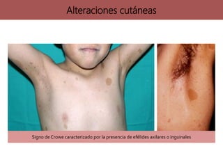 Alteraciones cutáneas
Signo de Crowe caracterizado por la presencia de efélides axilares o inguinales
 